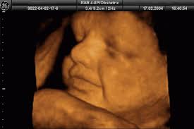 Những dấu hiệu thai nhi bị dị tật