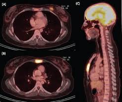 Surgical treatment in oligometastatic breast cancer