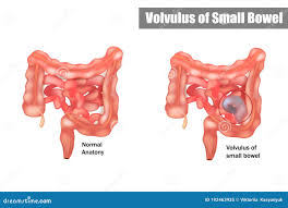Image result for Volvulus