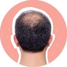 If you are under an inordinate amount of stress for a long period of time, don't be surprised if your hair gets thinner. A Guide To Damaged Hair And 15 Ways To Fix It