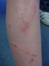 Picture of right inside elbow crease, he has eczema. Is It A Viral Rash Baby Toddler Rash Identification Ask Dr Sears