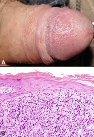 Lichen planus treatments stratum dermatology clinics. Lichen Planus And Lichenoid Dermatoses Clinical Overview And Molecular Basis Sciencedirect