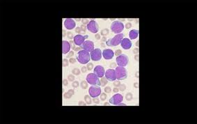 Check spelling or type a new query. Nueva Terapia Logra Remision Leucemia Linfoblastica Aguda 90 De Casos