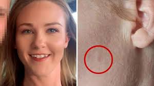 Image result for skin cancer on nose pimple