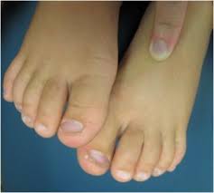 Image result for Koilonychia feet