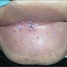 Why do i have creases on my stomach? Growths In Abdominal Folds Mdedge Family Medicine