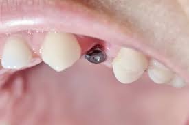 Image result for dental implant