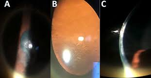 An Analysis of Interstitial Keratitis Secondary to Epstein-Barr Virus