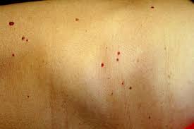 Cherry angiomas markedly increase in number from about the age of 40, so it has been estimated that 75% of people over 75 years of age have them. Cherry Angioma Symptoms Causes And Treatment
