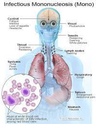Medical Definition Of Mononucleosis