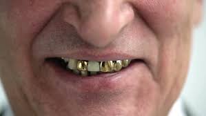 When you are getting a gold tooth, you are paying for a traditional dental implant (titanium or zirconia) and a gold dental crown. Smiling Old Man With Gold Stock Footage Video 100 Royalty Free 8498572 Shutterstock
