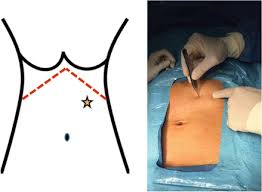 Hasson entry pack of instruments figure 2. Complications Of Port Placement Abdominal Key
