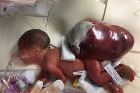 Abortion is a reality which is so horrific that words alone can never convey its meaning. Baby Born With Tumour Bigger Than Her Now Thriving After Parents Refuse Abortion World News Mirror Online