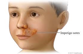 Image result for yellow scabs on the face in children