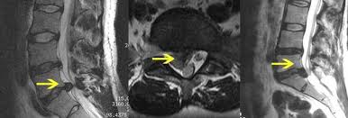 Prof Dr Christian Woiciechowsky Neurochirurgie Berlin Lendenwirbelsaule