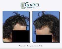 Watch A Patient S Real Time Growth After 3439 Grafts Gabel Center