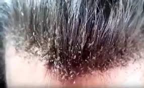 The strong chemicals in hair dye and bleach can often kill both lice and nymphs by drying them out. Will Hair Dye Kill Lice Iytmed Com