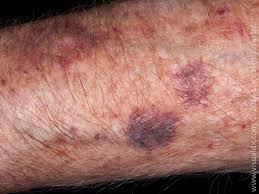 Malignant lesions of the skin are common. Learnderm Ecchymosis