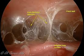 Image result for Parapneumonic Effusion