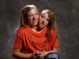 Can Conjoined Twins Like Abby and Brittany Hensel Have a Baby? OBGYN  Explains (Exclusive) - Parade
