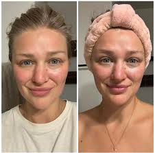 Lymphatic cream reduces allergy symptoms