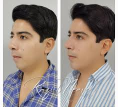 🔸Rinoplastia + Mentoplastia🔸 Mejora tu perfil facial, Dale mas definición  al rostro y ¡Luce increíble! Rinoplastia Primaria Funcional/Estética con  colocación de Implante de mentón Agenda tu cita ☎️55 5873 4429 📱442 452  5352 #DrRazielNeave ...