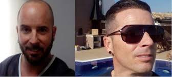 Before After Hair Transplantation Sacekimi Sacekimiuzmani Sacekimmerkezi Sacekimioncesi Sacekimisonrasi Drserkanaygin Hairtransplant H Sac Deri Trans