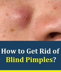 Since blind pimples are pimples that occur deep in the skin, they should be treated a bit differently. How To Get Rid Of Blind Pimples Diy Acne Treatment Blind Pimple Acne Treatment