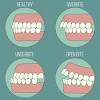 However, if it is very severe, often braces is the best non surgical method of treating an overbite. 1