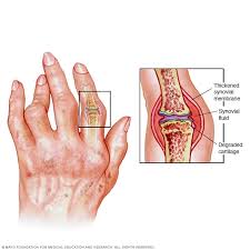 Different people have different symptoms for lung cancer. Rheumatoid Arthritis Symptoms And Causes Mayo Clinic
