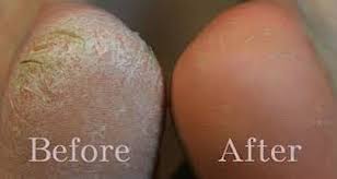 People With Cracked Dry Heels Can Be Extremely Unpleasant Issue And Even Painful However You Can Treat Your Callous Hee Sore Feet Scaly Skin Foot Remedies