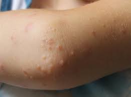 Small Raised Bumps On Elbows Elbow Bump Small