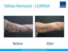 The light energy is converted to heat energy and the ink. Tattoo Removal Machines Treatment Lynton Lasers
