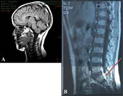 Research how to enrich your life through healthy living. Pallister Hall Syndrome With Orofacial Narrowing And Tethered Cord A Case Report Journal Of Medical Case Reports Full Text