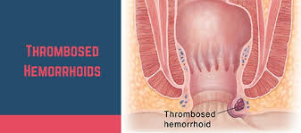 A thrombosed external hemorrhoid can be diagnosed just by looking at it. 4 Types Of Hemorrhoids That Can Affect You Get Rid Of It At Giguy