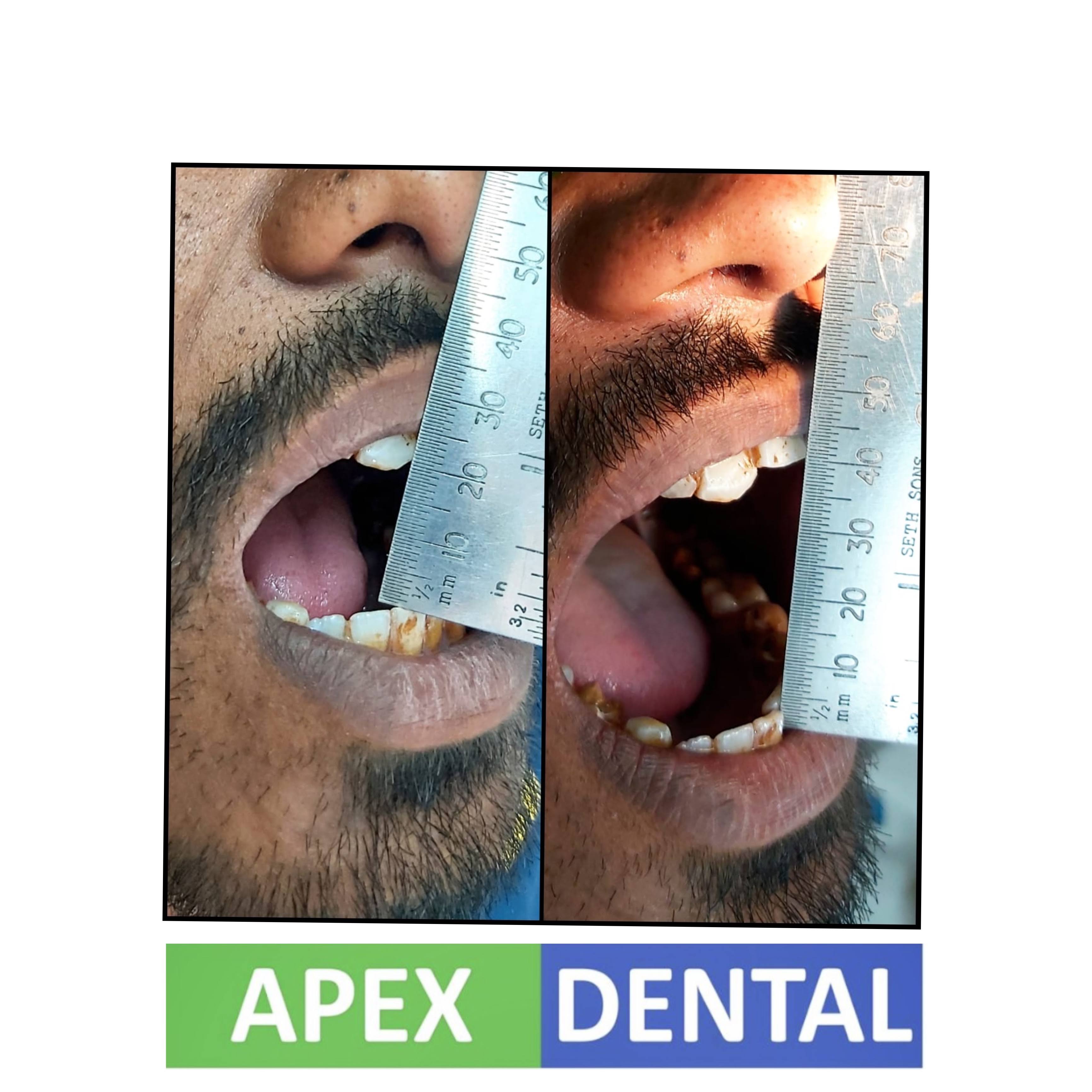 Laser Osmf product image