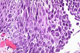 Herpesvirus (hsv) esophagitis is seen predominantly in patients who are immunocompromised. Infection