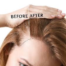 Hairline Lowering Surgery Or Hair Transplant All You Need To Know