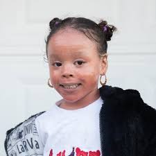 Nyla was born with Ichthyosis, meaning her skin grows too fast 🤍