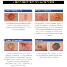 Existen dos tipos de cáncer de piel no melanoma: Sabes Cuando Sospechar Un Cancer De Piel Signos Y Sintomas Para La Deteccion Precoz Del Cancer De Piel Tipo Melanoma Y No Melanoma 13 Junio Dia Munial Cancer De Piel