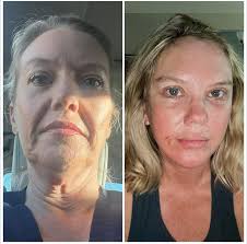 Grateful to highlight her remarkable beauty with #EspinoLift — where  precision meets elegance. She kindly shared her own photos to show her  journey. #nomakeup just her own beauty! Don't forget to follow