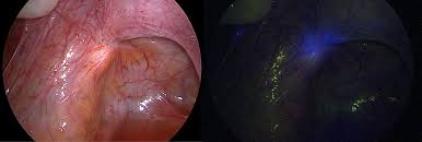 Maybe you would like to learn more about one of these? Visualization Of Endometriosis With Laparoscopy And Near Infrared Optics With Indocyanine Green Siegenthaler 2020 Acta Obstetricia Et Gynecologica Scandinavica Wiley Online Library