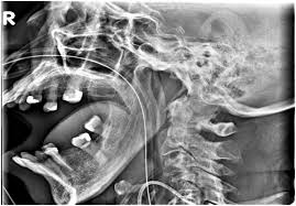 Image result for Jaw Dislocation