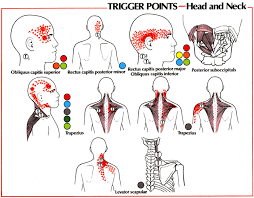 Trial ow chart that displays the protocol of this study. Trigger Point Referral Patterns Chart Detikak