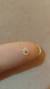 Infected Ingrown Hair Cyst