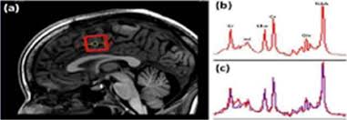 Cingulate cortex is the part of cortex associated with learning, emotions, and memory. Scielo Brasil Effect Of Monolingualism And Bilingualism In The Anterior Cingulate Cortex A Proton Magnetic Resonance Spectroscopy Study In Two Centers Effect Of Monolingualism And Bilingualism In The Anterior Cingulate