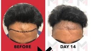 Hair follicles work in stages, continuously cycling through growth, rest and regrowth, and there are times when hair can become very long. Stem Cell Hair Therapy Restore Growth Of Natural Hair Follicles Istanbul Trambellir