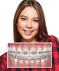 Types of Braces