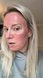 24 hours post bbl/halo laser! #skincare #dermatology #lasertreatment  #bblhalo #bbl #halolaser #precancer