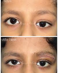 Image result for Proptosis